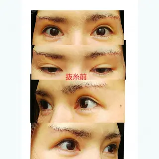 6日目の経過画像（1枚目）