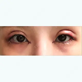 1日目の経過画像（1枚目）