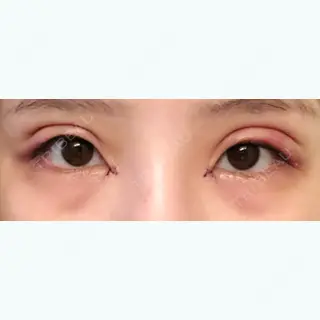 2日目の経過画像（1枚目）
