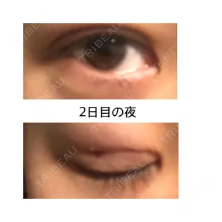 2日目の経過画像（1枚目）