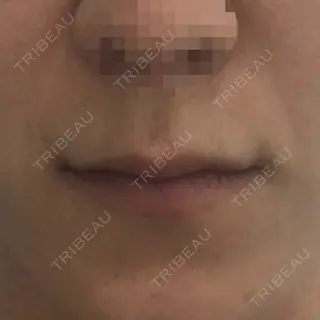8日目の経過画像（1枚目）