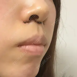 6日目の経過画像（1枚目）