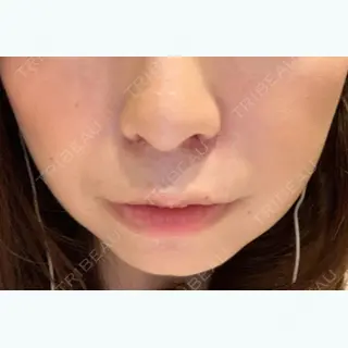 6日目の経過画像（1枚目）