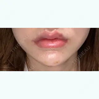 0日目の経過画像（1枚目）