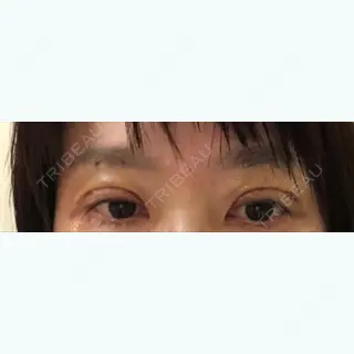 4日目の経過画像（1枚目）