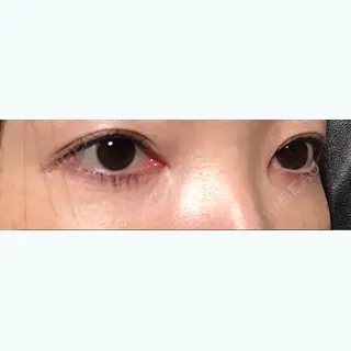11日目の経過画像（3枚目）