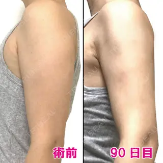 90日目の経過画像（1枚目）