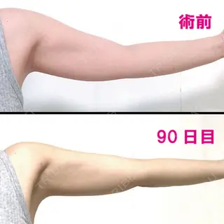 90日目の経過画像（2枚目）