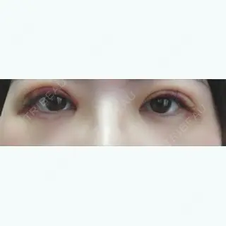 3日目の経過画像（2枚目）