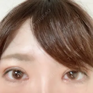 12日目の経過画像（1枚目）
