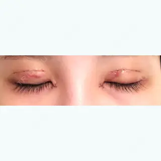 5日目の経過画像（3枚目）