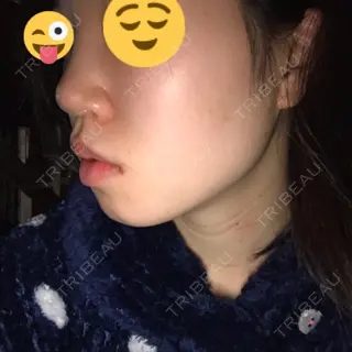 9日目の経過画像（2枚目）