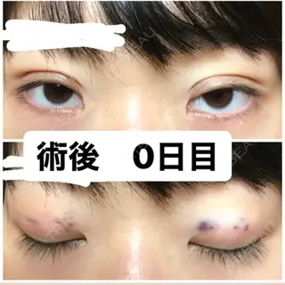 0日目の経過画像（1枚目）