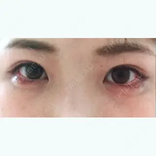 3日目の経過画像（1枚目）