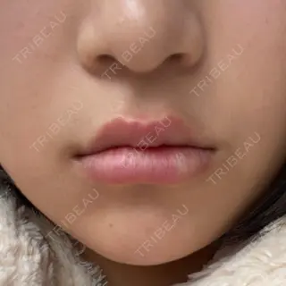 0日目の経過画像（1枚目）