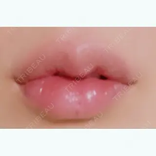 4日目の経過画像（1枚目）