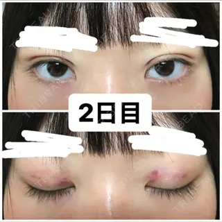2日目の経過画像（1枚目）