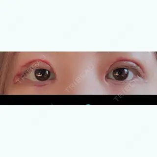 7日目の経過画像（1枚目）