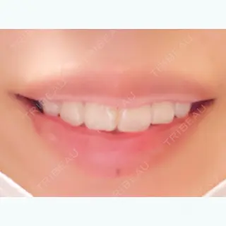 5日目の経過画像（2枚目）