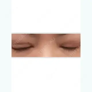 3日目の経過画像（3枚目）