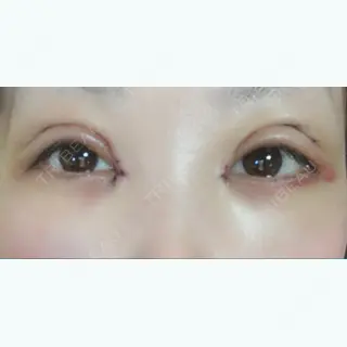4日目の経過画像（1枚目）