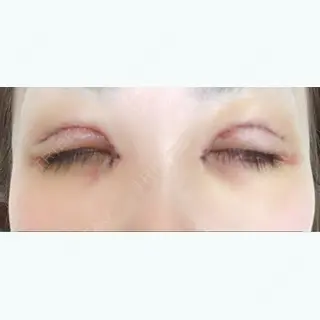 5日目の経過画像（2枚目）