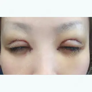 6日目の経過画像（3枚目）
