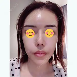 0日目の経過画像（1枚目）