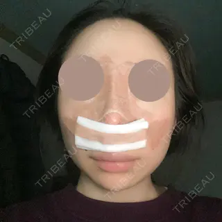 2日目の経過画像（2枚目）