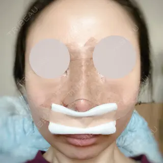 2日目の経過画像（1枚目）
