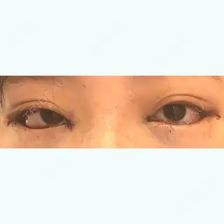 0日目の経過画像（1枚目）