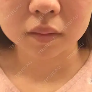 6日目の経過画像（1枚目）