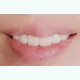 6日目の経過画像（2枚目）