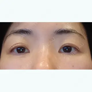 12日目の経過画像（1枚目）