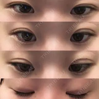 3日目の経過画像（1枚目）