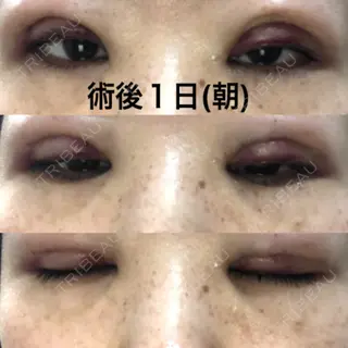 1日目の経過画像（1枚目）