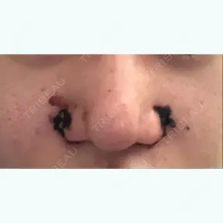 1日目の経過画像（1枚目）