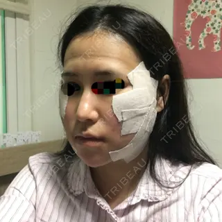 2日目の経過画像（2枚目）