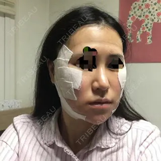 2日目の経過画像（3枚目）