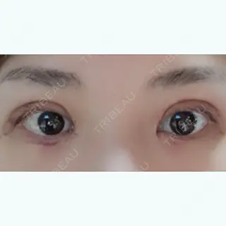 9日目の経過画像（1枚目）