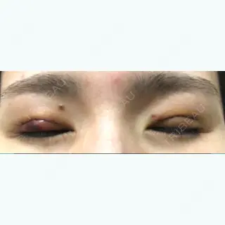 0日目の経過画像（2枚目）