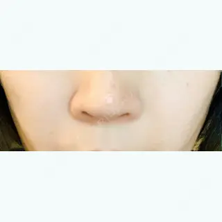 34日目の経過画像（1枚目）