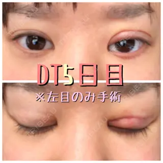 5日目の経過画像（1枚目）
