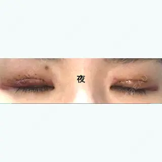 1日目の経過画像（3枚目）