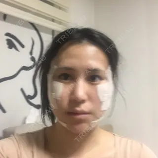 3日目の経過画像（1枚目）