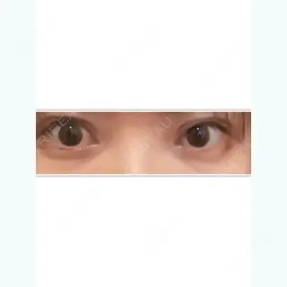 6日目の経過画像（1枚目）