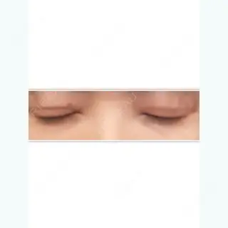 6日目の経過画像（3枚目）