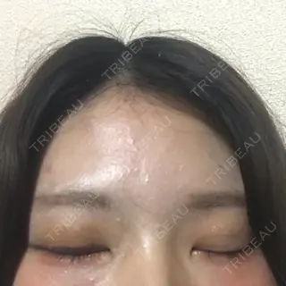2日目の経過画像（2枚目）