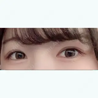 65日目の経過画像（2枚目）