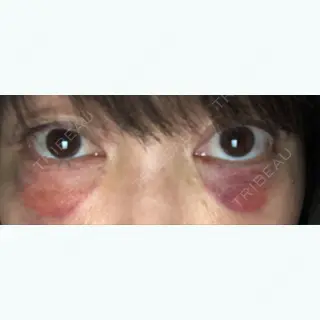 2日目の経過画像（1枚目）